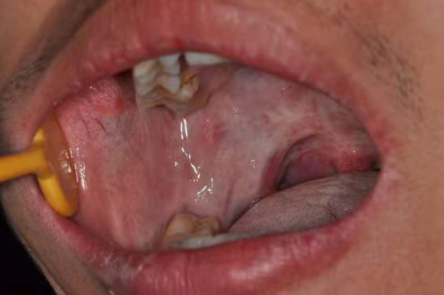 吃槟榔口腔癌征兆图片