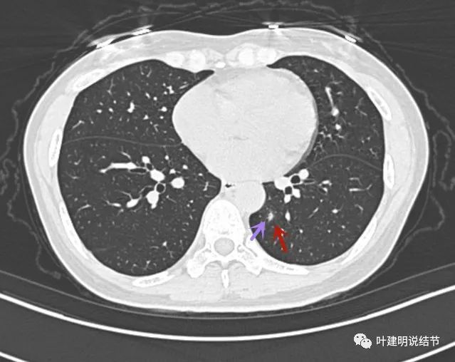 11.2):加拿大華人來問診肺小結節,我誤診了!反思一下