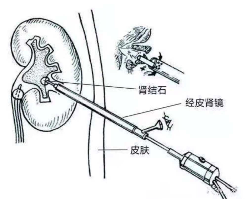 肾结石如何进行经皮肾镜取石术治疗