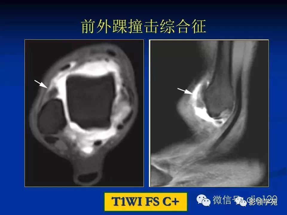 踝关节撞击综合征 腾讯网