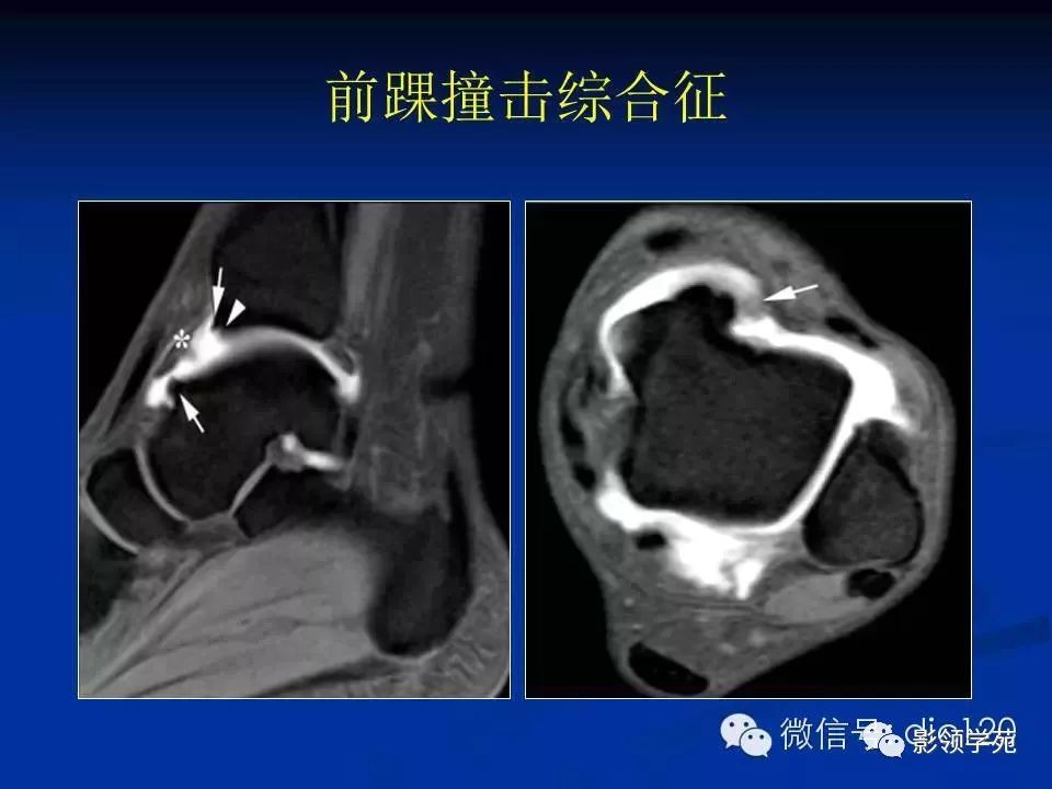 踝关节旋后损伤通常导致距腓前韧带,跟腓韧带以及前外侧关节囊撕裂