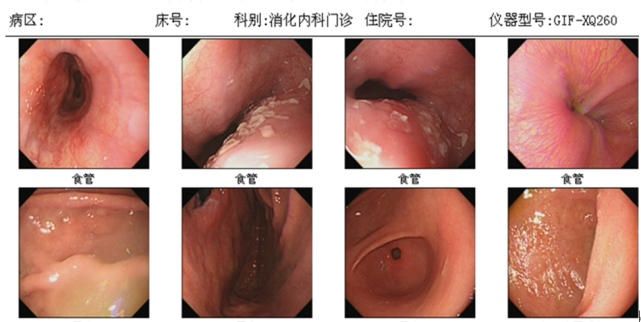 肝膽胰脾彩超檢查無異常,胃鏡檢查提示真菌性食管炎,故門診以