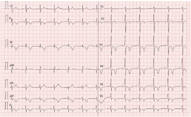病例广泛性t波倒置的一个被低估的原因