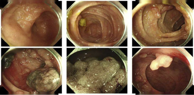 息肉为什么会恶变