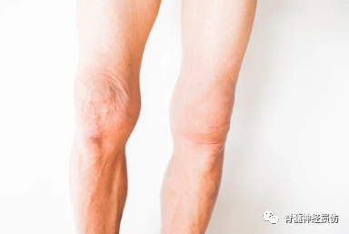 引起肌肉萎缩的原因有哪些