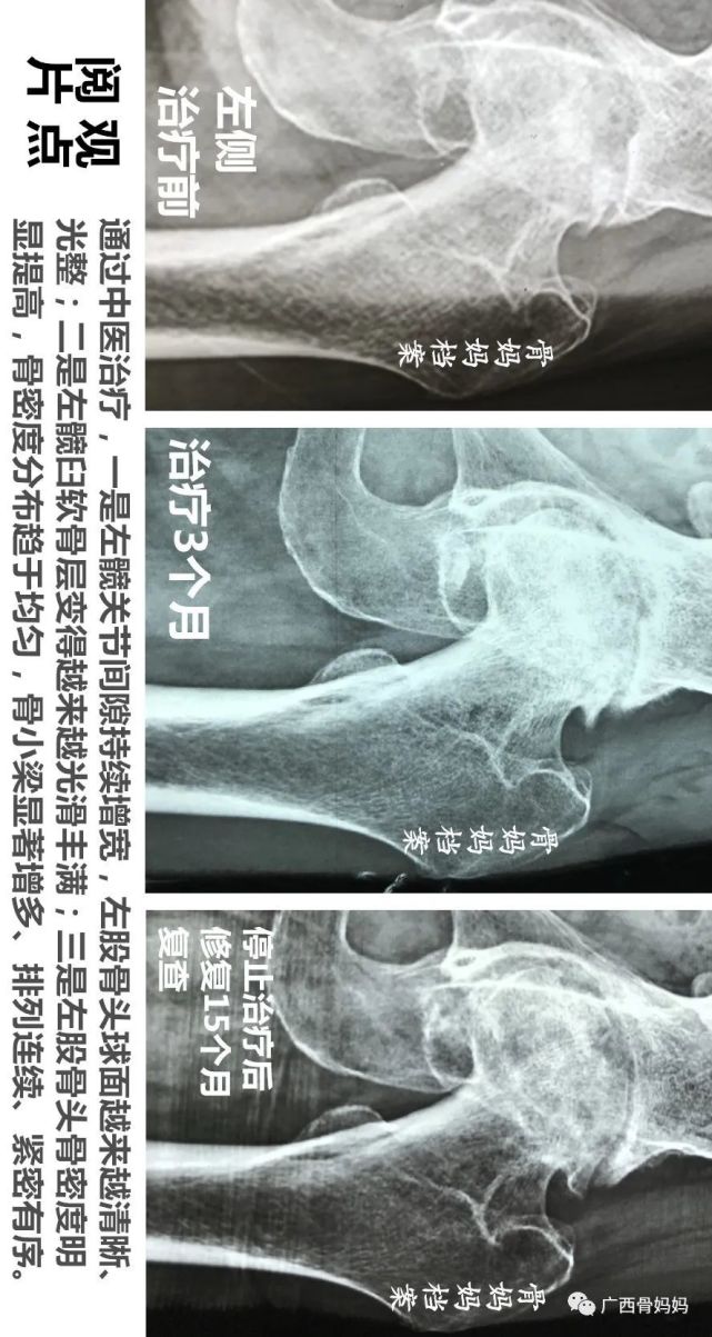 股骨頭壞死康復治療的x線片觀察右側股骨頭消失了中醫治療還能怎樣