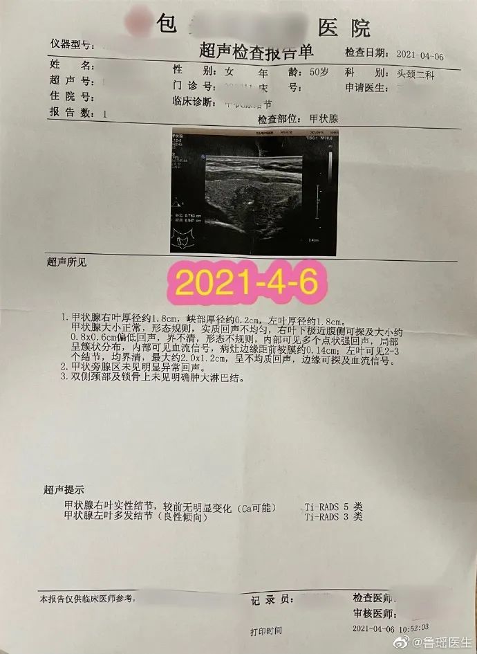 8釐米,邊界不清,形態不規則,簇狀鈣化,不能排除惡性形態.2021年1月份