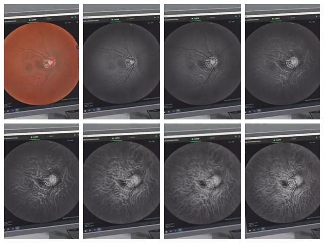 组织病理学检查发现所有因巩膜外压所致的闭角型青光眼,脉络膜上腔内