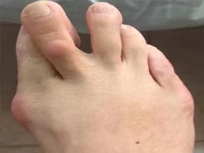 退休大姐跳完广场舞大脚趾67竟痛67到没法穿鞋这个病专害女人