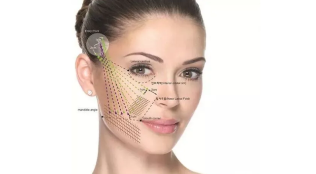 ppdo线雕维持时间ppdo线雕是什么线怎么抵挡岁月侵染