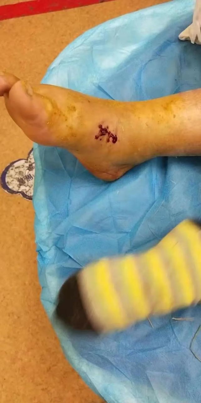 就在警卫指引下到达泉州中医院急诊楼,将被咬伤阿婆交给等待的医生
