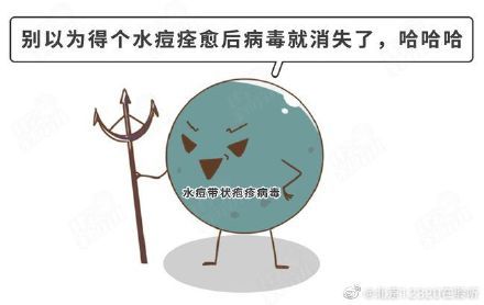 带状疱疹会传染吗