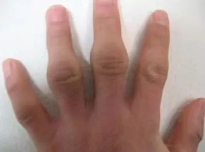 手指变粗,指甲变形,一查竟是癌!别不信!出现这些"异样"或是大病信号