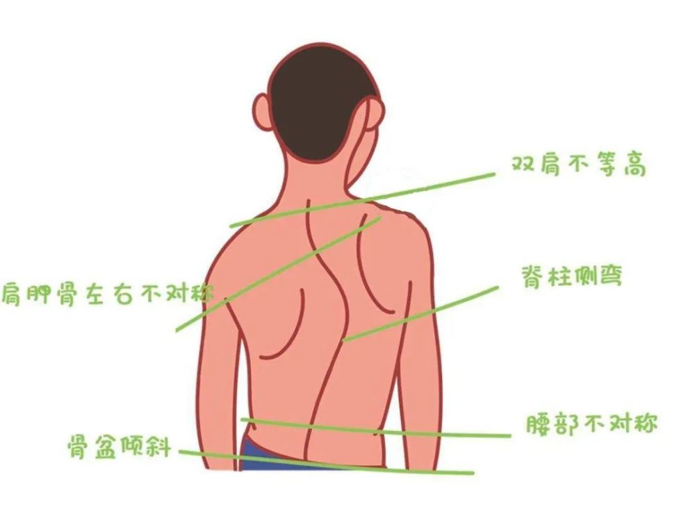 家長們需掌握一個動作測試孩子有沒有脊柱側彎