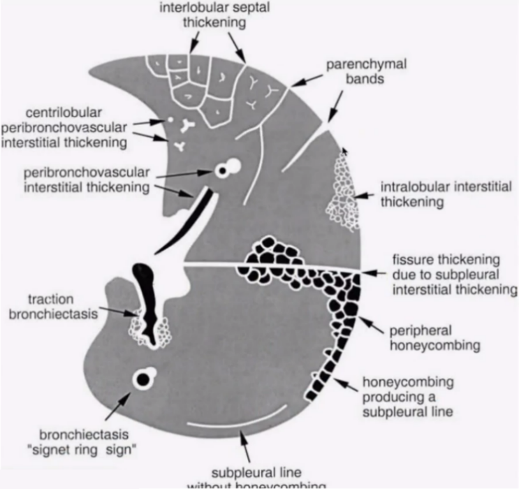 图17 肺部大网格,小网格和蜂窝等结构示意图那小叶间隔增厚有哪些特点