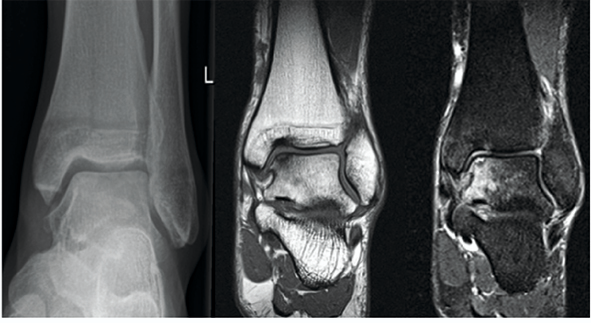 迟到一个月的踝关节骨折