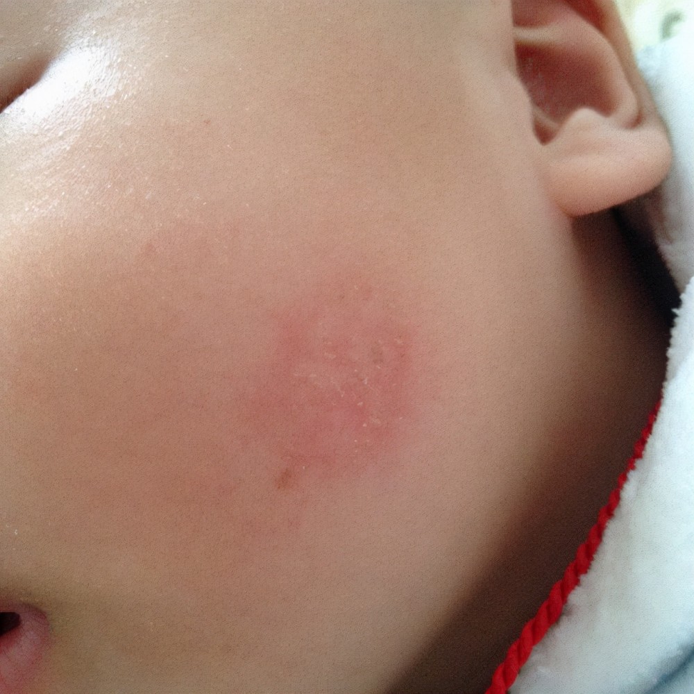 孩子在秋冬季容易出现皮肤问题用对方法就可以改善护理要及时