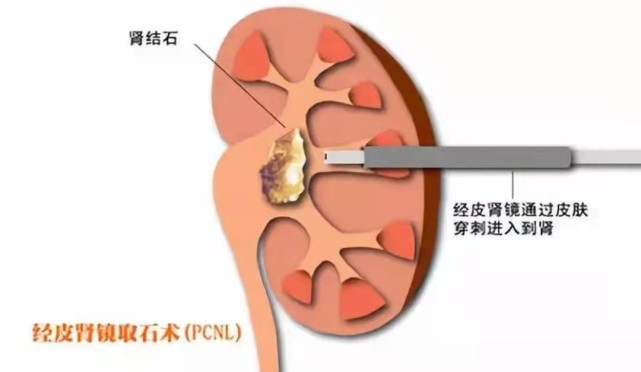 dj管|血尿|输尿管|尿频|输尿管狭窄|膀胱