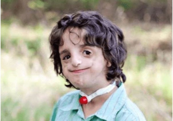 英国男子先天脸部畸形,凭个人魅力娶了个美娇妻,孩子出生后笑不出来