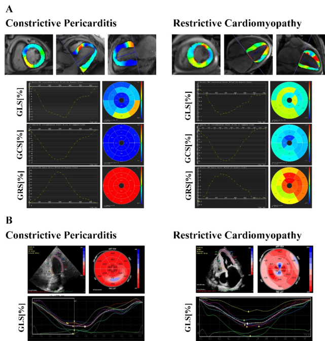 同一患者分别行a:心脏磁共振组织追踪分析(cmr-ft)和b:斑点追踪超声