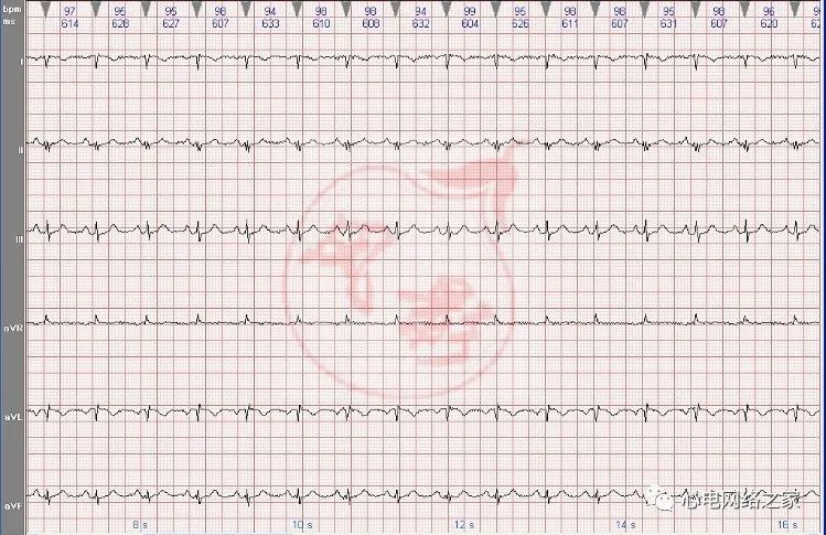 心電圖知識25右位心