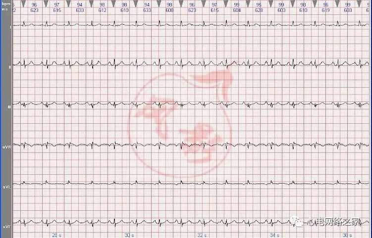 常规导联记录这是一份右位心窦性心律的心电图,患者男性27岁,体检患者