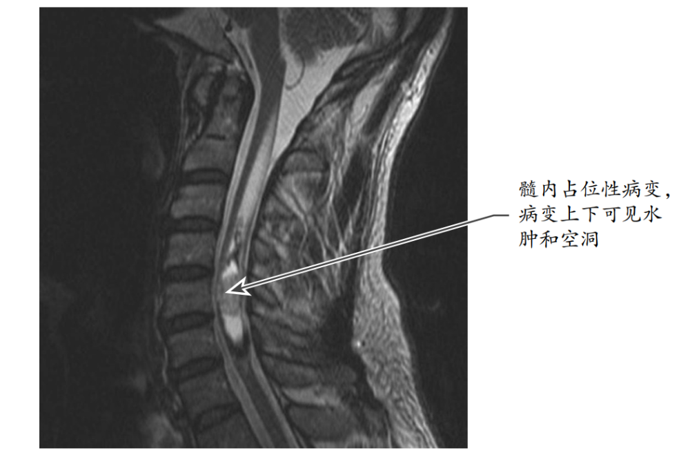 脊髓脊膜瘤图片