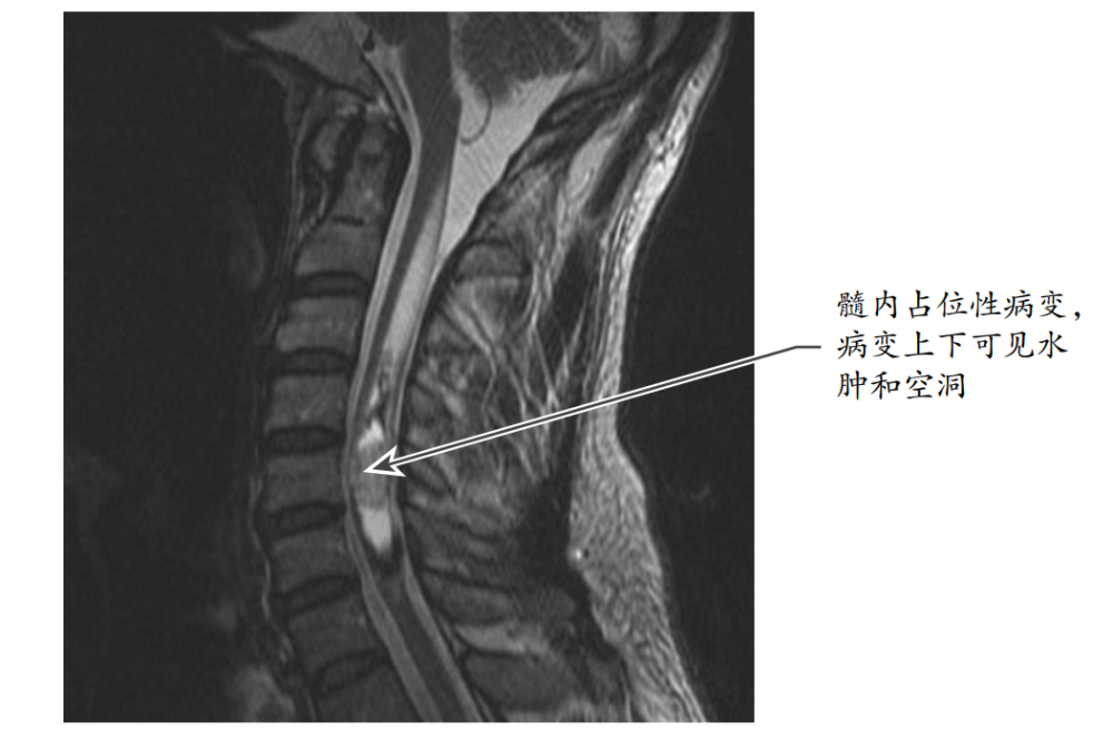 脊髓内肿瘤的诊疗