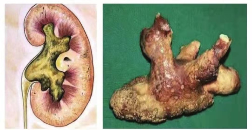 為什麼複雜感染性腎結石需要分期手術