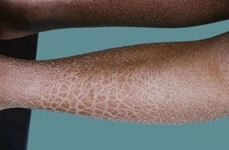 冬季就脱皮,特别是小腿,甚至还会出现瘙痒不适,大多数人只当皮肤缺水