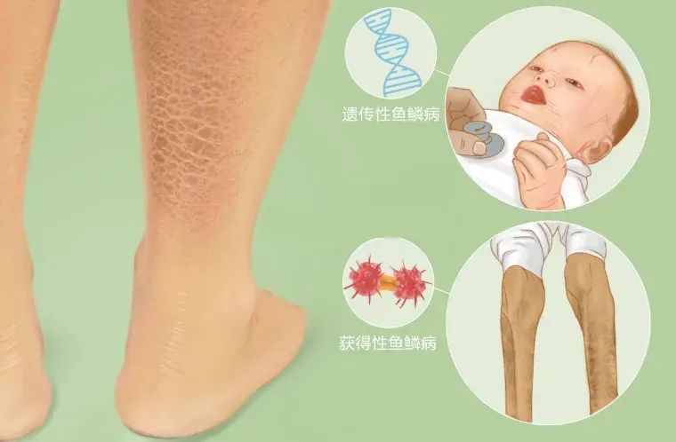 肤康 科普 难看又难受的鱼鳞病是怎么引起的 对身体影响有多大 腾讯新闻