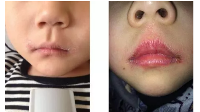 小心是得了这种病!|嘴唇|孩子|慢性唇炎|瘙痒