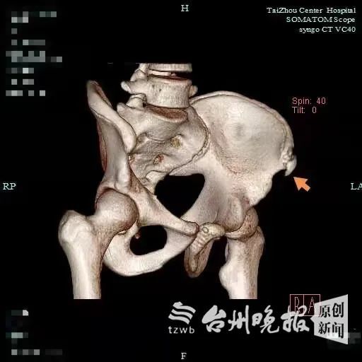 髂前上棘骨折是盯着青少年的"专属"疾病,如何判断自家孩子有没有"中招