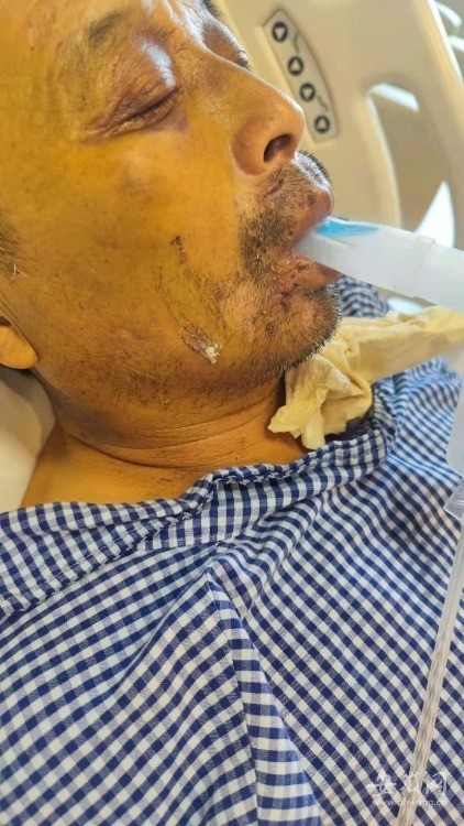 合肥:工人高架桥墩下工作 被钢板模砸中致十根肋骨骨折