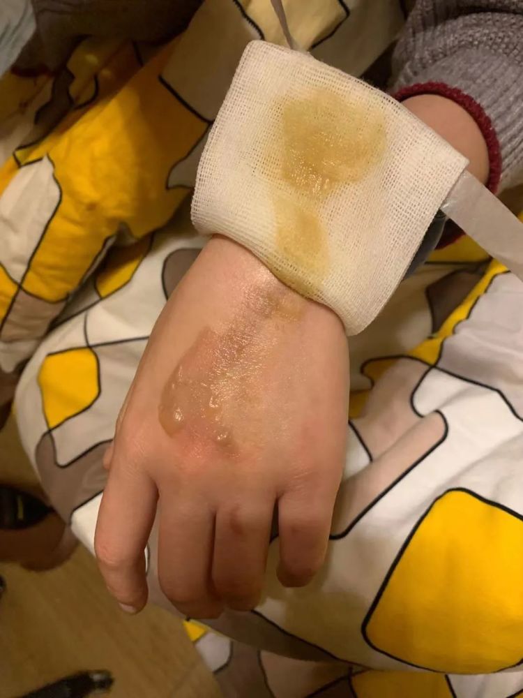 手烫伤,两个年轻人没有声张,随便擦点酒精抹点烫伤膏,纱布简单包扎后