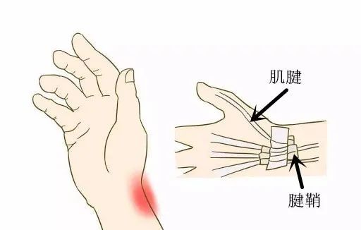 腱鞘炎是怎麼形成的5個方法幫你緩解腱鞘炎症狀67