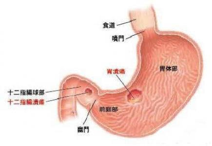 五,胃潰瘍,表現為