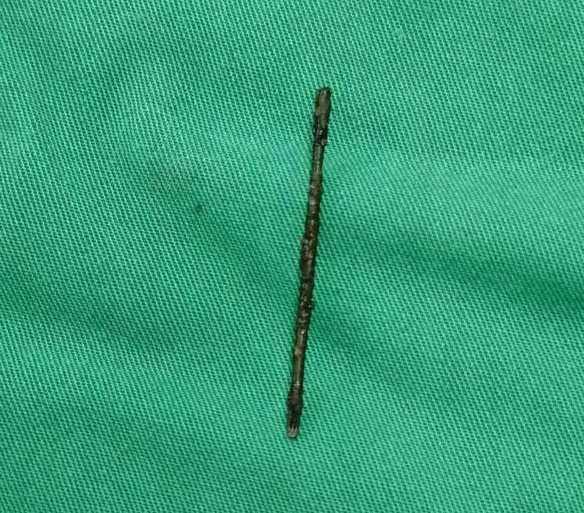 差点出大事!一根"绣花针"竟藏身体里二十多年,医生:运气太好了