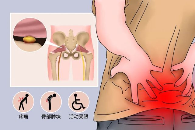 小宇課堂體外衝擊波治療梨狀肌綜合徵