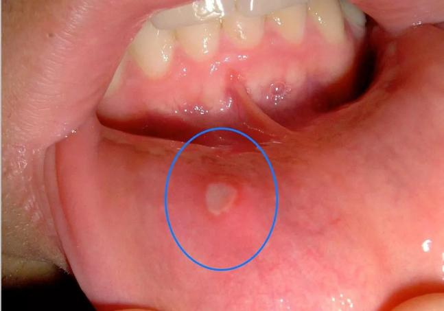 宝宝得口腔溃疡后,溃疡周围会红肿,表面是黄色,中间凹陷,通常都比较疼