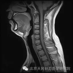 頸椎mri解剖知識與常用數據總結!