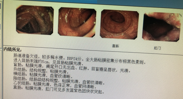 悔不当初,男子肠子粗得碗口大,全因常吃乱吃这东西!