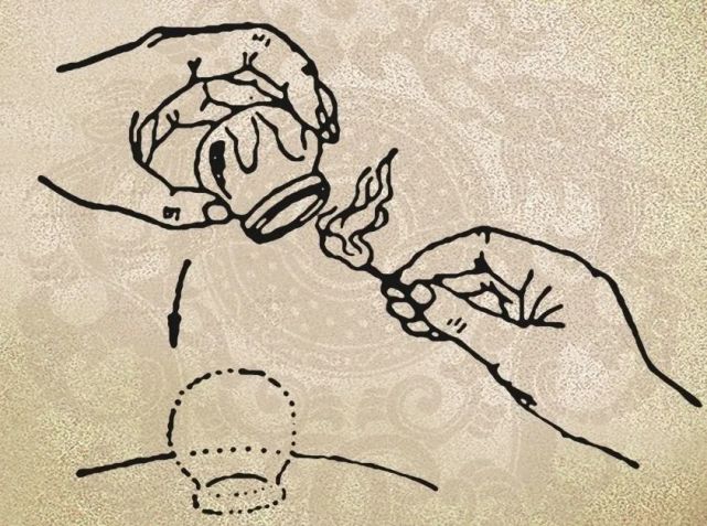 的华人科学家林灏(hao lin)将传统的拔罐疗法应用于新冠疫苗的注射