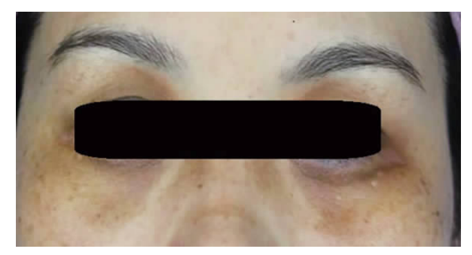 类型黑眼圈主要原因是表皮或真皮的色素增多(包括一些眼周的太田痣等