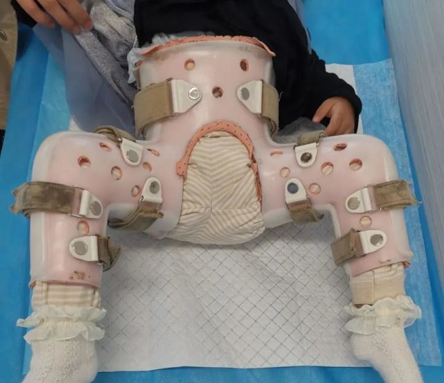 在福建省儿童医院治疗了一段时间,经过三个月石膏固定,髋关节已逐渐