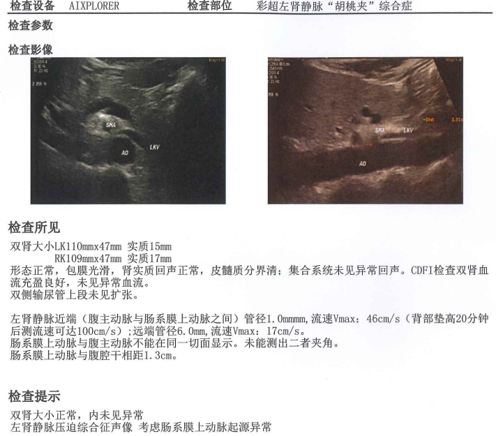 胡桃夹综合征超声图片