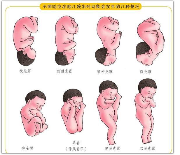而头部仰伸,臀部在下,横卧,斜卧等姿势则属于胎位不正.