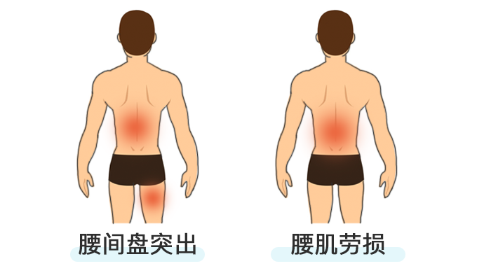 腰肌劳损症状位置图图片