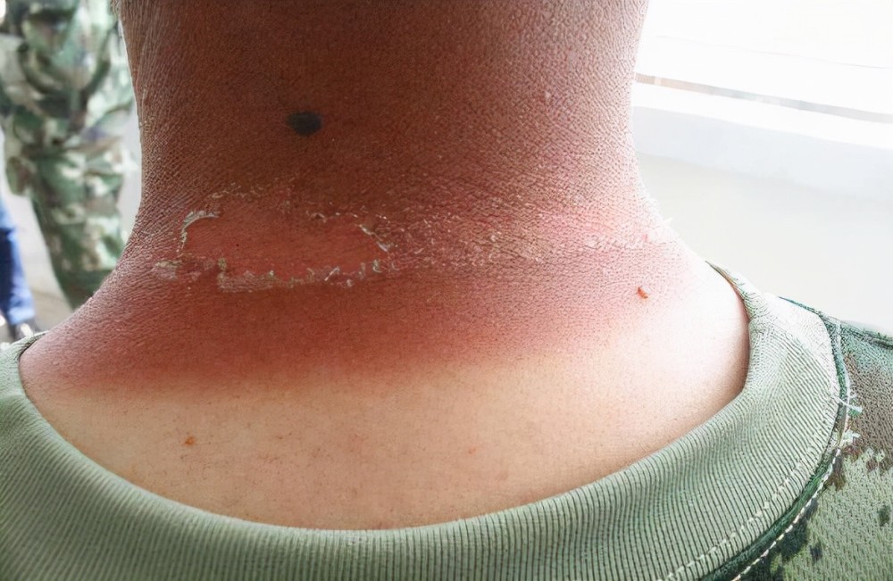 面对太阳光的照射,人类的皮肤似乎是地球上物种最敏感的动物.