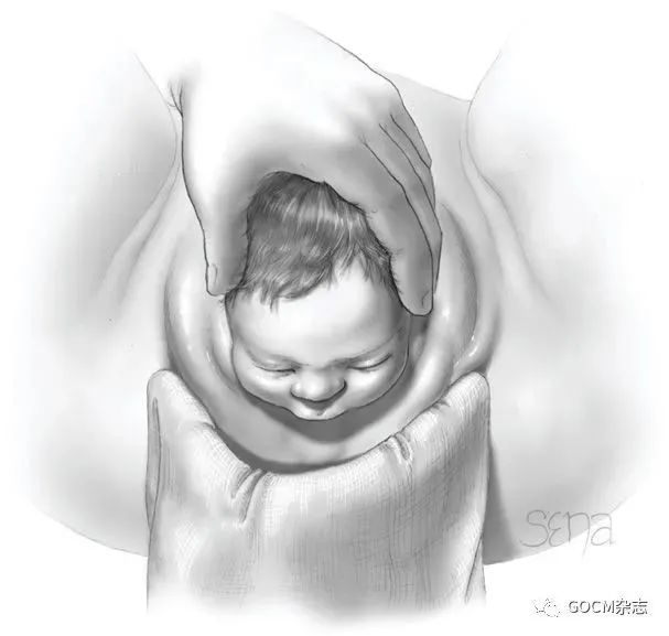 传统助产,会阴侧切,无创助产,三种技术对产妇盆底功能有何影响?